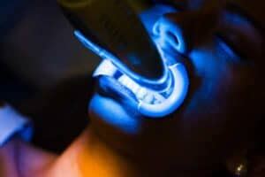 Teeth Whitening Experts, Leatherhead .